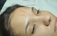 Acupuntura Facial