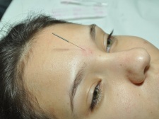 Acupuntura Facial