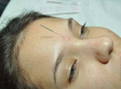 Acupuntura Facial