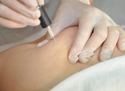Carboxiterapia Carboxiterapia