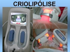 Criolipólise Criolipólise