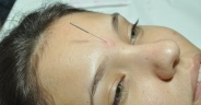 Acupuntura Facial